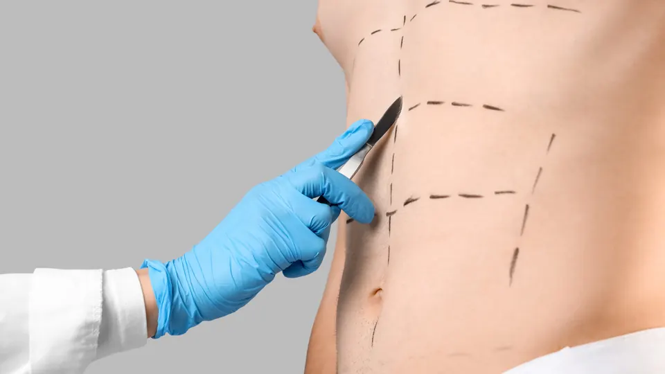 Lipoaspiração de Alta Definição